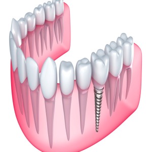 Tooth Implant Sydney Natural-looking Teeth Artificial Tooth Australia-http://toothimplantsydney.com.au