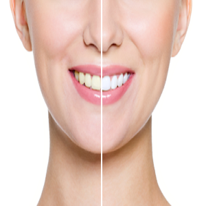 Teeth Whitening
