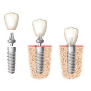 Tooth implants sydney