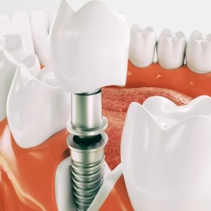 Dr Paulo Pinho Dental Implants,Wisdom Teeth Removal Sydney Australia-http://www.drpaulopinho.com.au