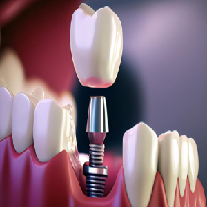 Tooth Implant Sydney Natural-looking Teeth Artificial Tooth Australia-http://toothimplantsydney.com.au