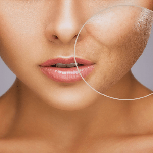 Microneedling