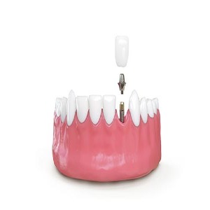 Professional Emergency Dentist Epping 