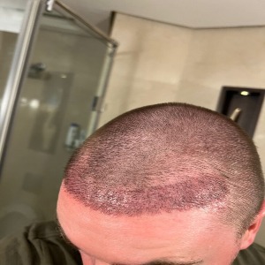 hair transplant
